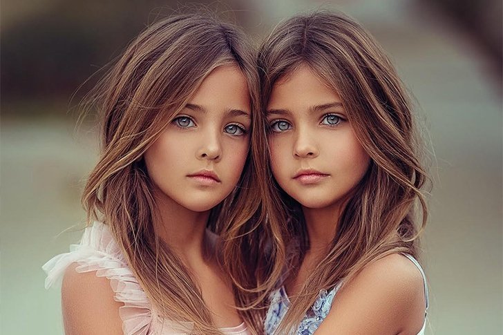 Nobody Thought It Was Possible But These Identical Sisters Have Grown