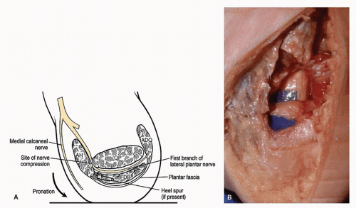 The Distal Tarsal Tunnel First Branch of the Lateral