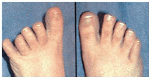 The Distal Tarsal Tunnel First Branch of the Lateral