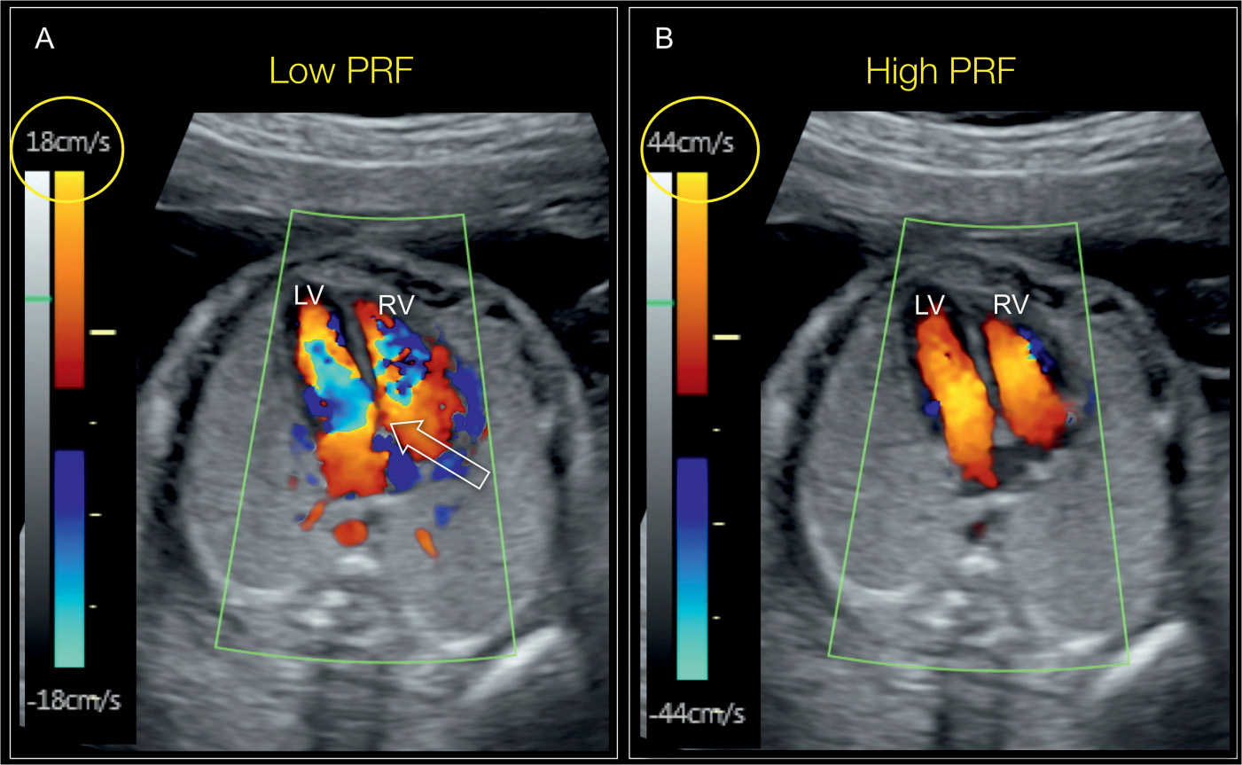 Color Doppler in Fetal Echocardiography Obgyn Key