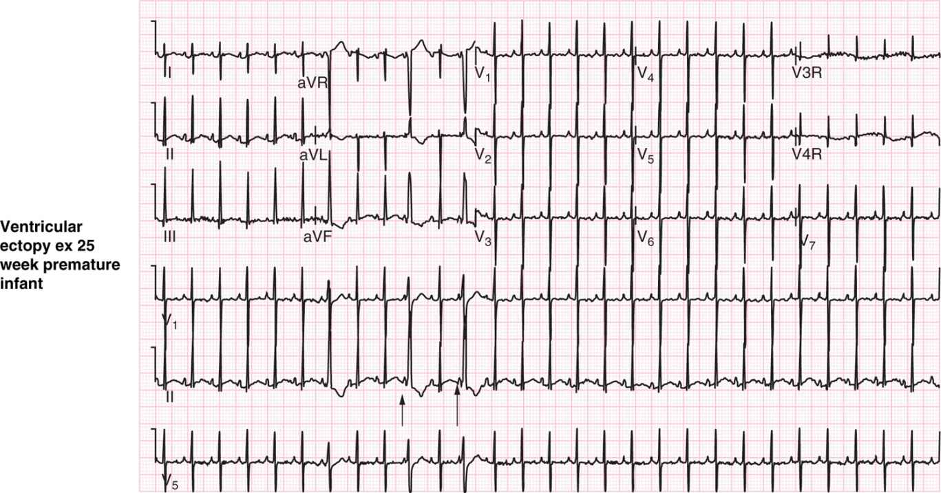 Neonatal Arrhythmias Obgyn Key