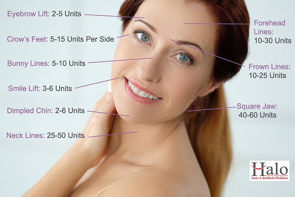 Botox for Wrinkles and Fine Lines Halo Medicine