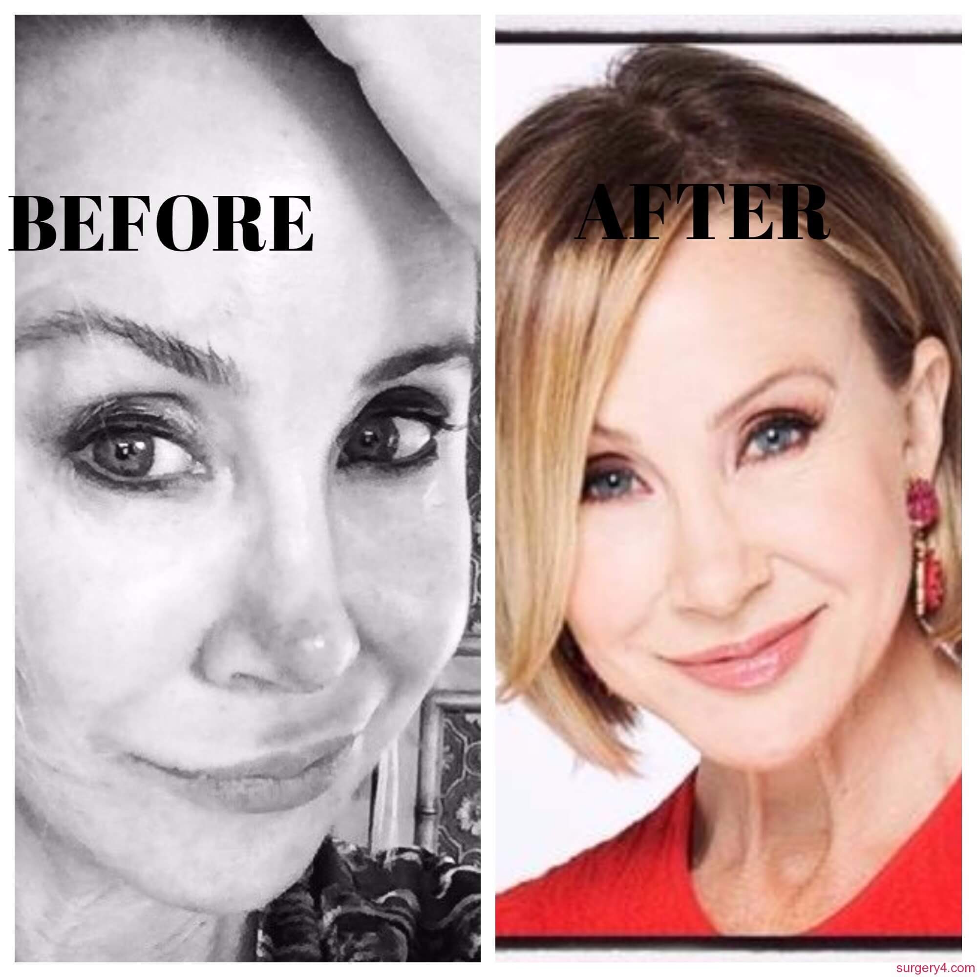 Lisa Robertson Face Lift Photos [Before & After] ⋆ Surgery4