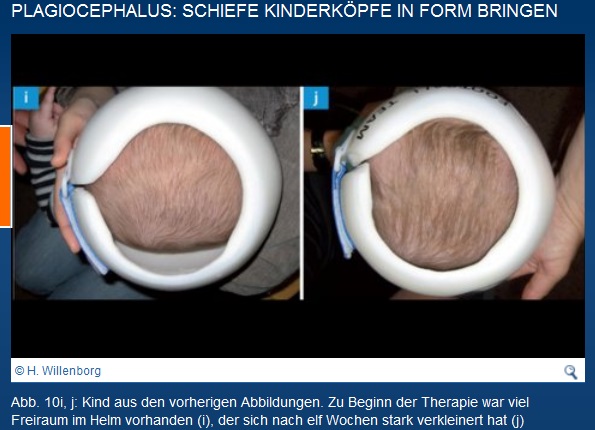 Helmtherapie Hat jemand Erfahrung Page 5 BabyForum.at