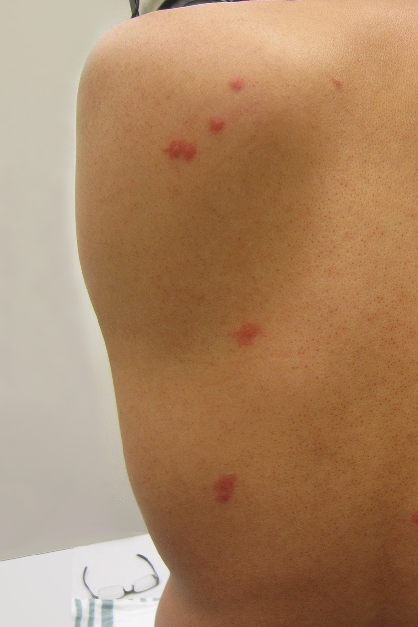Bed Bug Bites Treatment In Philadelphia, PA 2672820022