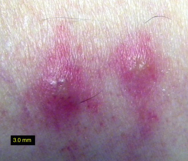 Dog Rash on Belly Causes, Pictures, and Treatment of Rash