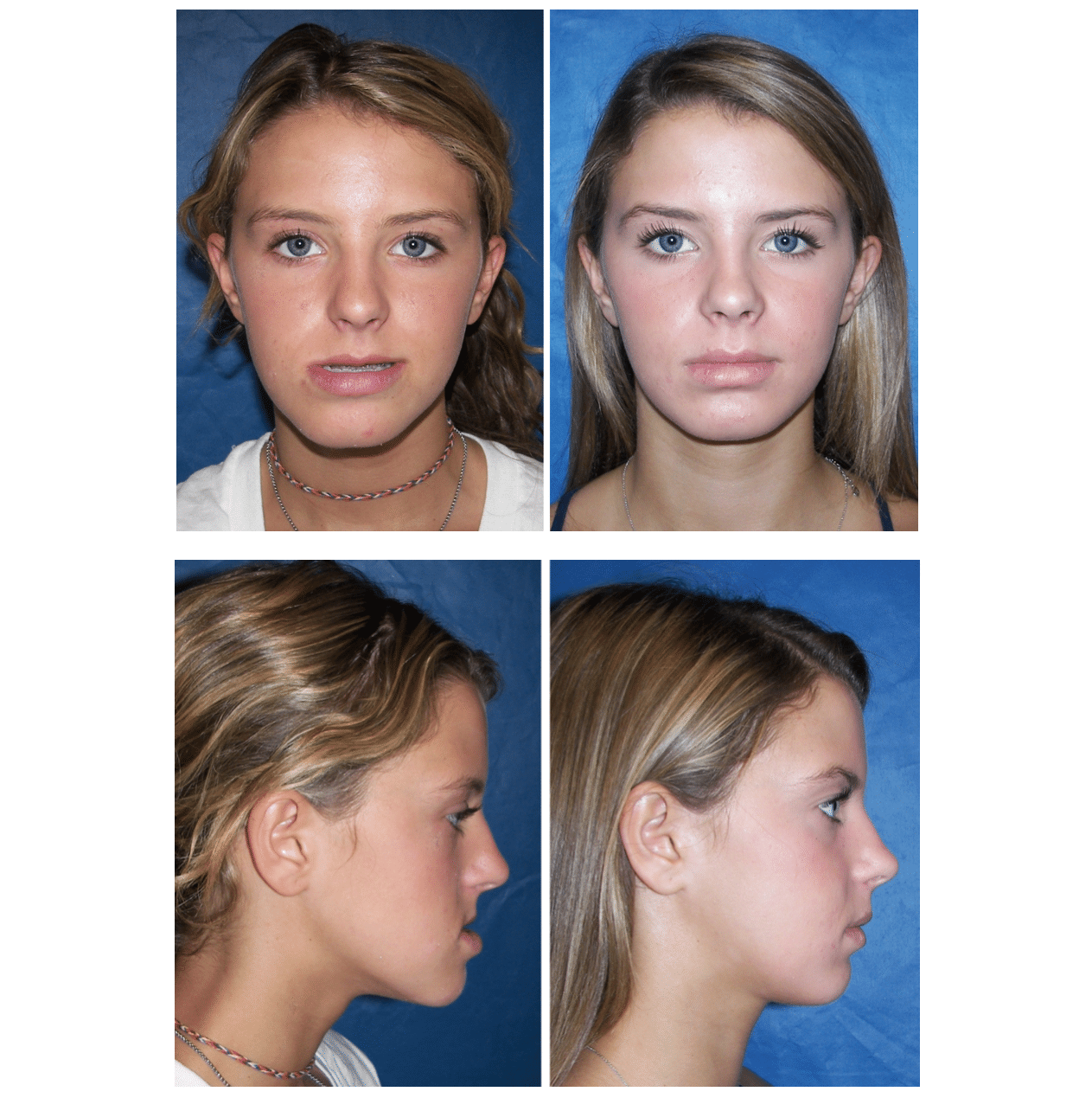 Orthognathic Surgery