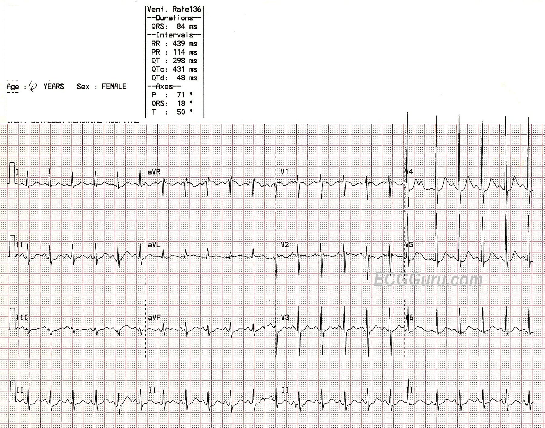 Sinus Tachycardia in a Child ECG Guru Instructor Resources