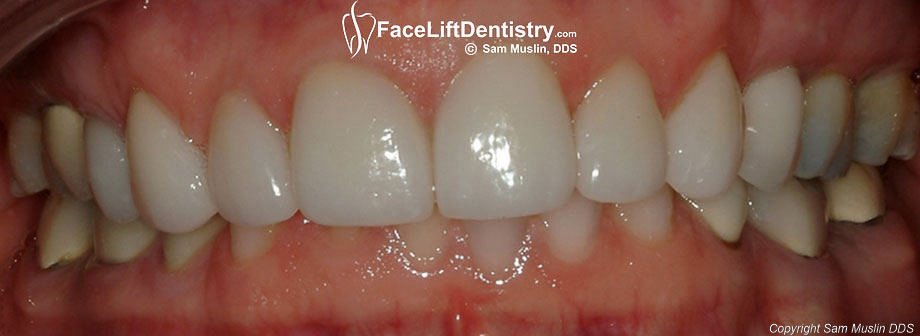 What is an Overbite and How Does it Affect You?