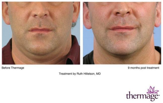 Thermage Costs, Information, Before & After Photos