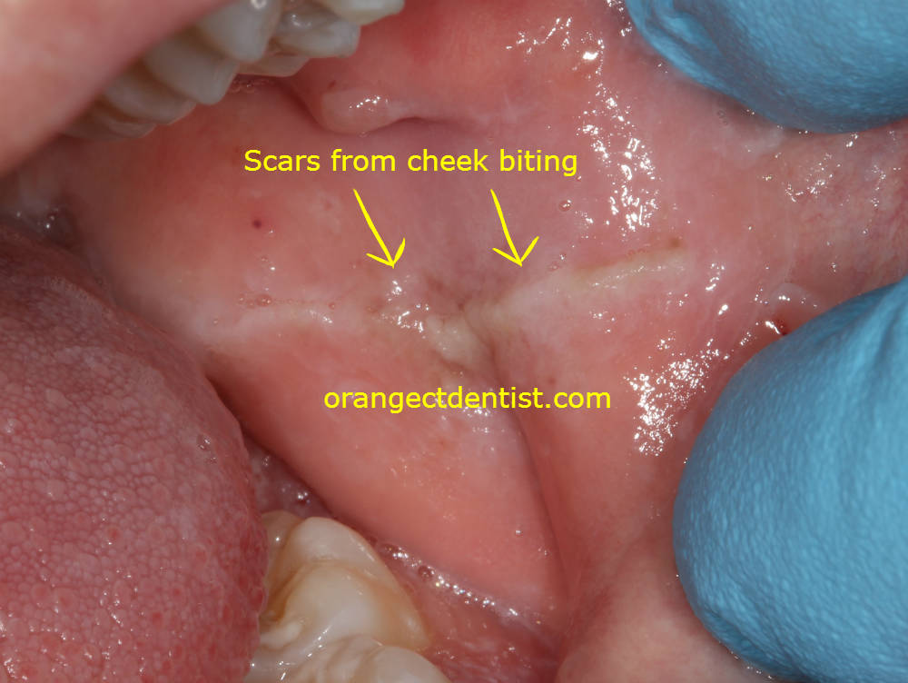 Cheek Biting Calcaterra Dentistry Orange Woodbridge Milford Ct