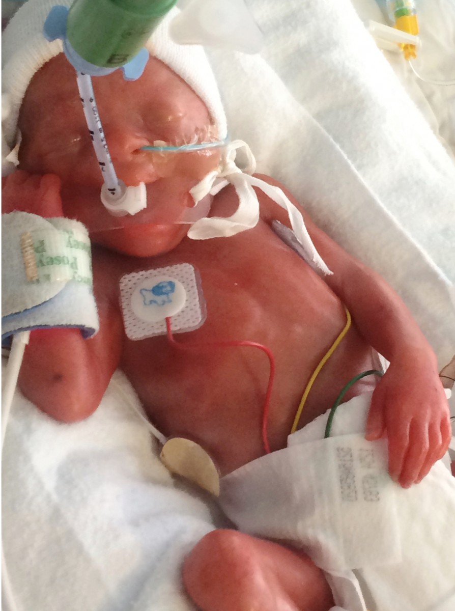 Baby born 15 weeks early is the same size as a PINT GLASS real fix