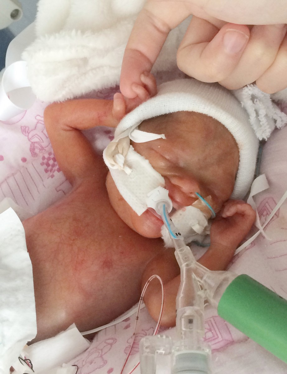 Baby born 15 weeks early is the same size as a PINT GLASS real fix