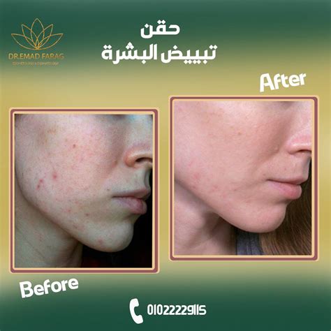  تبييض البشرة بالليزر في مصر |  التكاليف والعيادات والمزيد |  مستحضرات التجميل