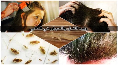  تفسير الأحلام عن القمل في الشعر للمرأة المتزوجة |  مجلة المرأة