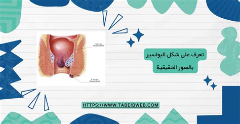  شكل البواسير الخارجية عند الحامل |  الجراحة الإيرانية