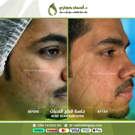  ليزر كربوني في جدة بأسعار 2024 |  الدكتور  أسماء حجازي