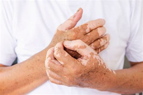 أعراض البهاق وأسبابه وعلاجه - طب الويب