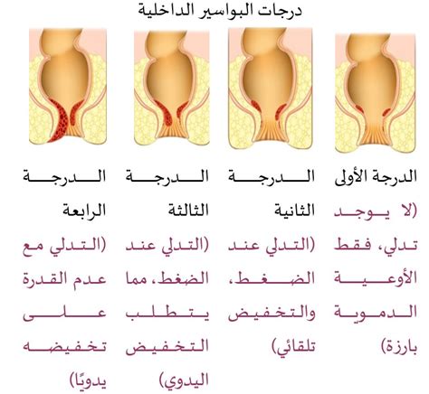 أعراض البواسير عند النساء تتعرف عليها - في اليوم السابع
