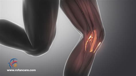 أعراض تمزق الرباط الصليبي وطرق تخفيفه