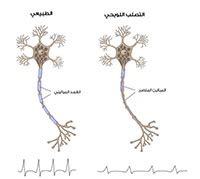 أعراض وأسباب وعلاج التصلب اللويحي - طب الويب