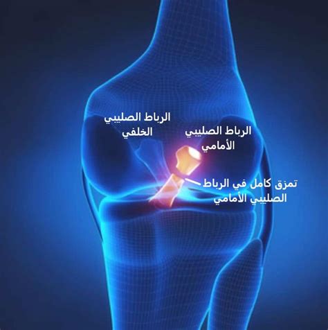 أكثر ثمانية أعراض للرباط الصليبي شيوعًا وأنواعها وعلاجها - صحة Duxpert