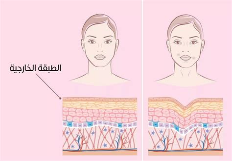 إنها الطبقة العلوية من الجلد التي تشكل الدرع الواقي للجسم