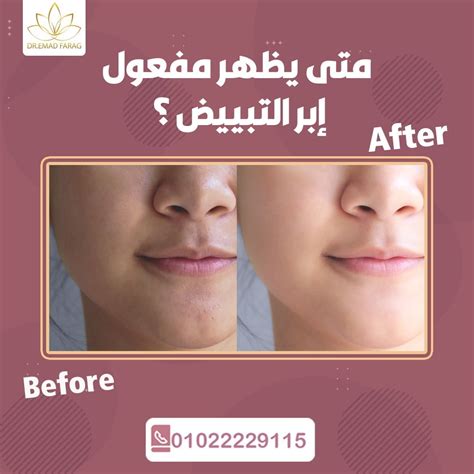 ابر التبييض في عيادات العدامة وما اضرارها - موسوعة الازهر