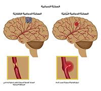 السكتة الدماغية الأسباب، الأعراض والعلاج - ويب طب السكتة الدماغية الأسباب، الأعراض والعلاج - ويب طب