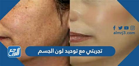 تجربتي مع توحيد لون الجسم بالليزر - الموسوعة العربية