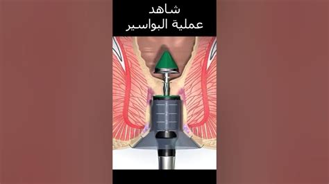 ثقب الشرج في الحلم