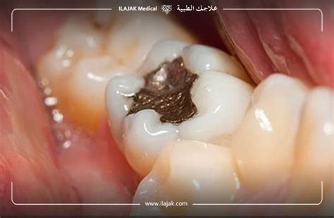 حشوات الأسنان بالأسمنت الأبيض - أفضل إجابة