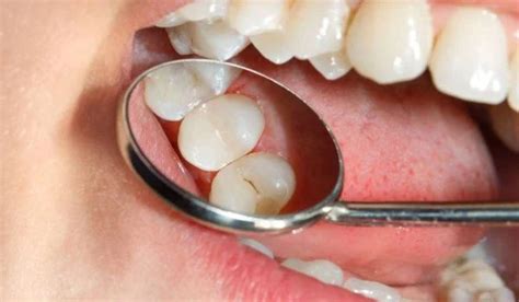 حشوات الاسنان بالاسمنت الابيض - الاخبار السابقة