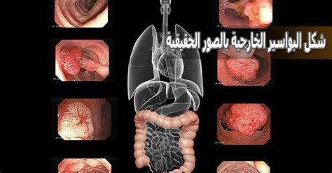 شكل البواسير الخارجية عند النساء بالصور الحقيقية - الصفحة المرجعية