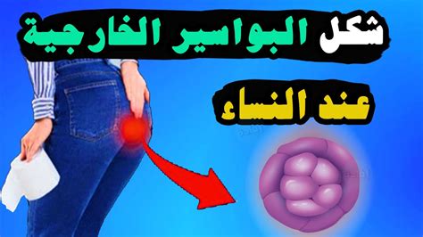 شكل البواسير الخارجية عند النساء - مكان الزيادة