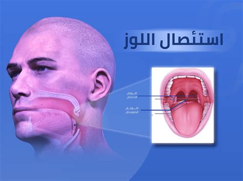 مؤخرة الحلق