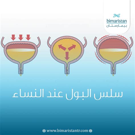 ما هو سلس البول عند النساء