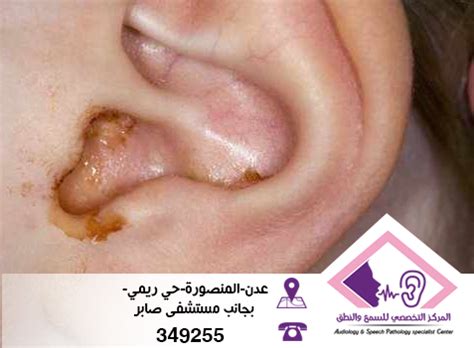 مادة شمعية تفرزها الاذن كومة - باك نيوز