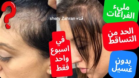 منع وزيادة تساقط الشعر - موضوع منع وزيادة تساقط الشعر - موضوع