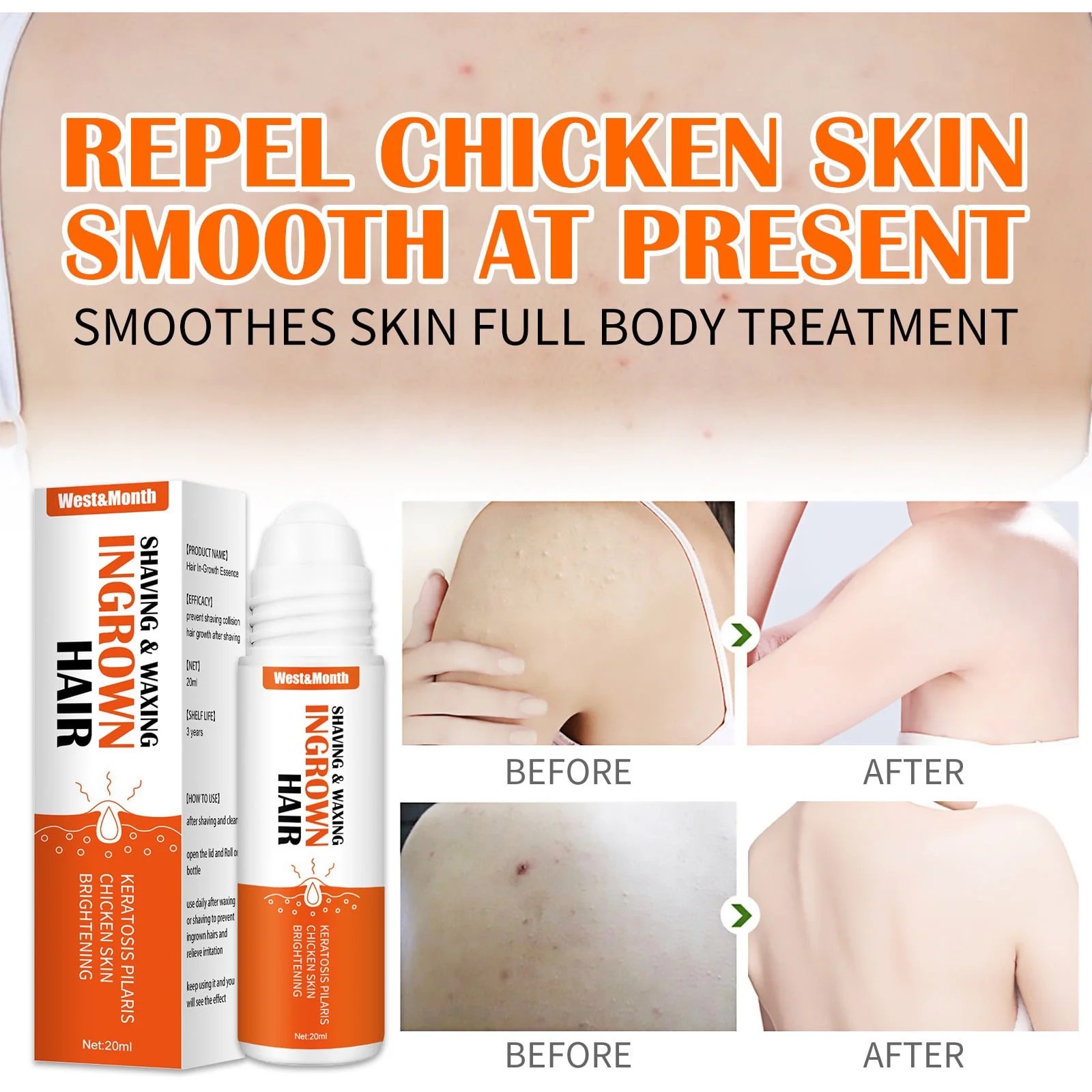 Ingrown Hair Removal