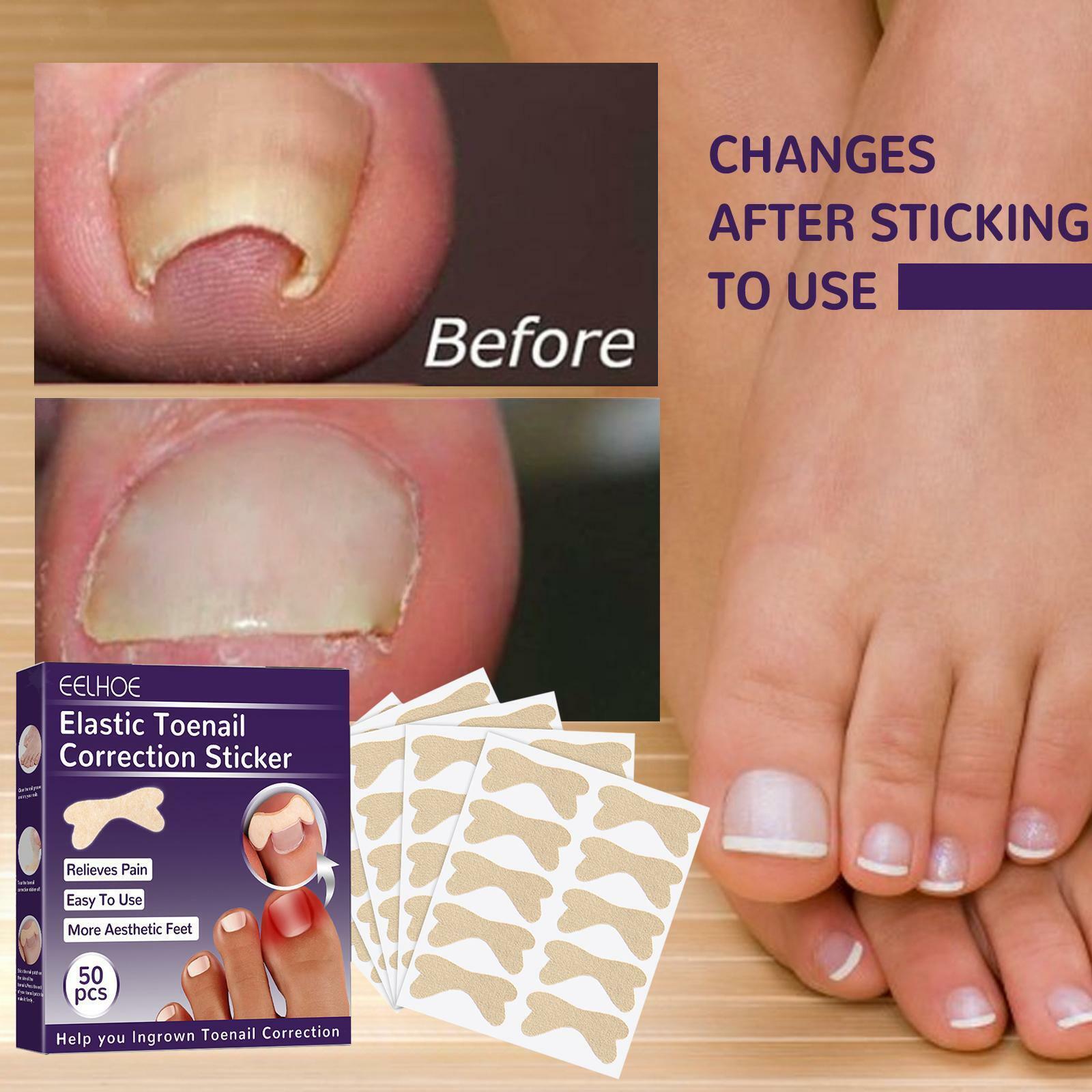 Curved Toenails Treatment My Bios