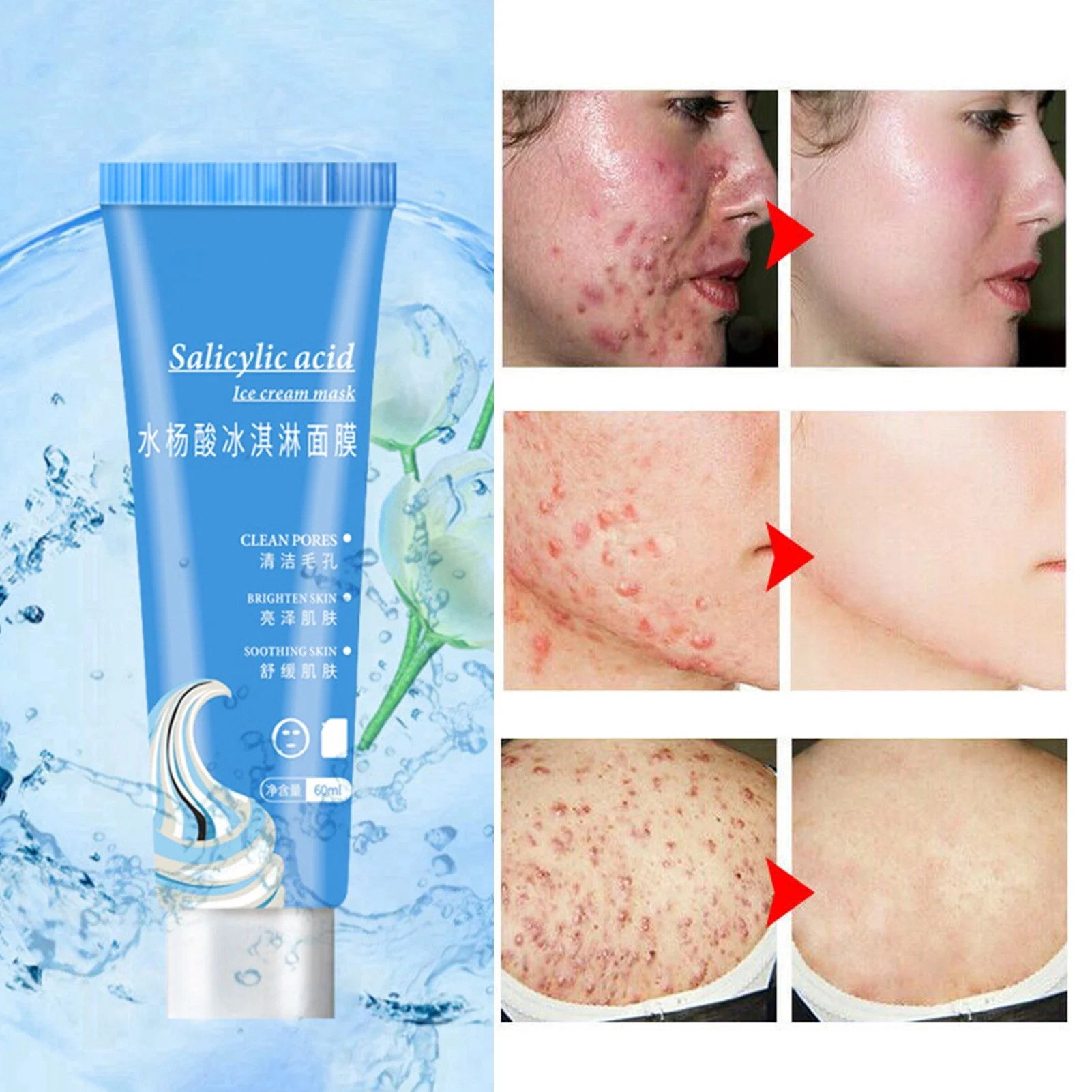 The Best Products For Treating Big Blackheads (Dermatologist Approved