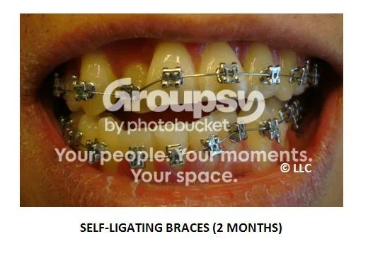 How much do dental braces cost nowadays? Page 3