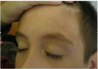 Ibima Publishing Pityriasis Versicolor On The Face-Wrong First Diagnosis Of Vitiligo -