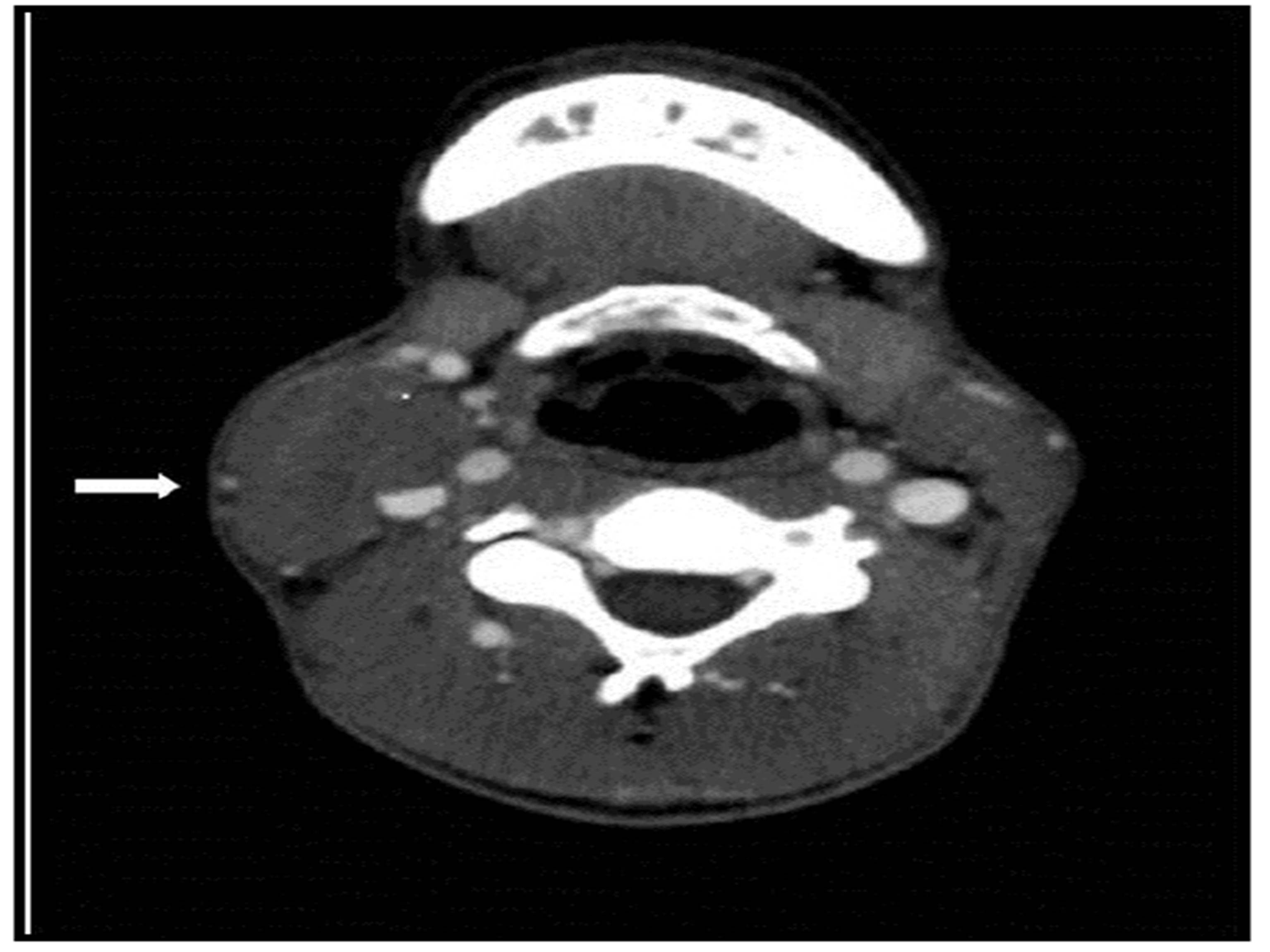IBIMA Publishing Carotid Sinus Syndrome In A Patient With