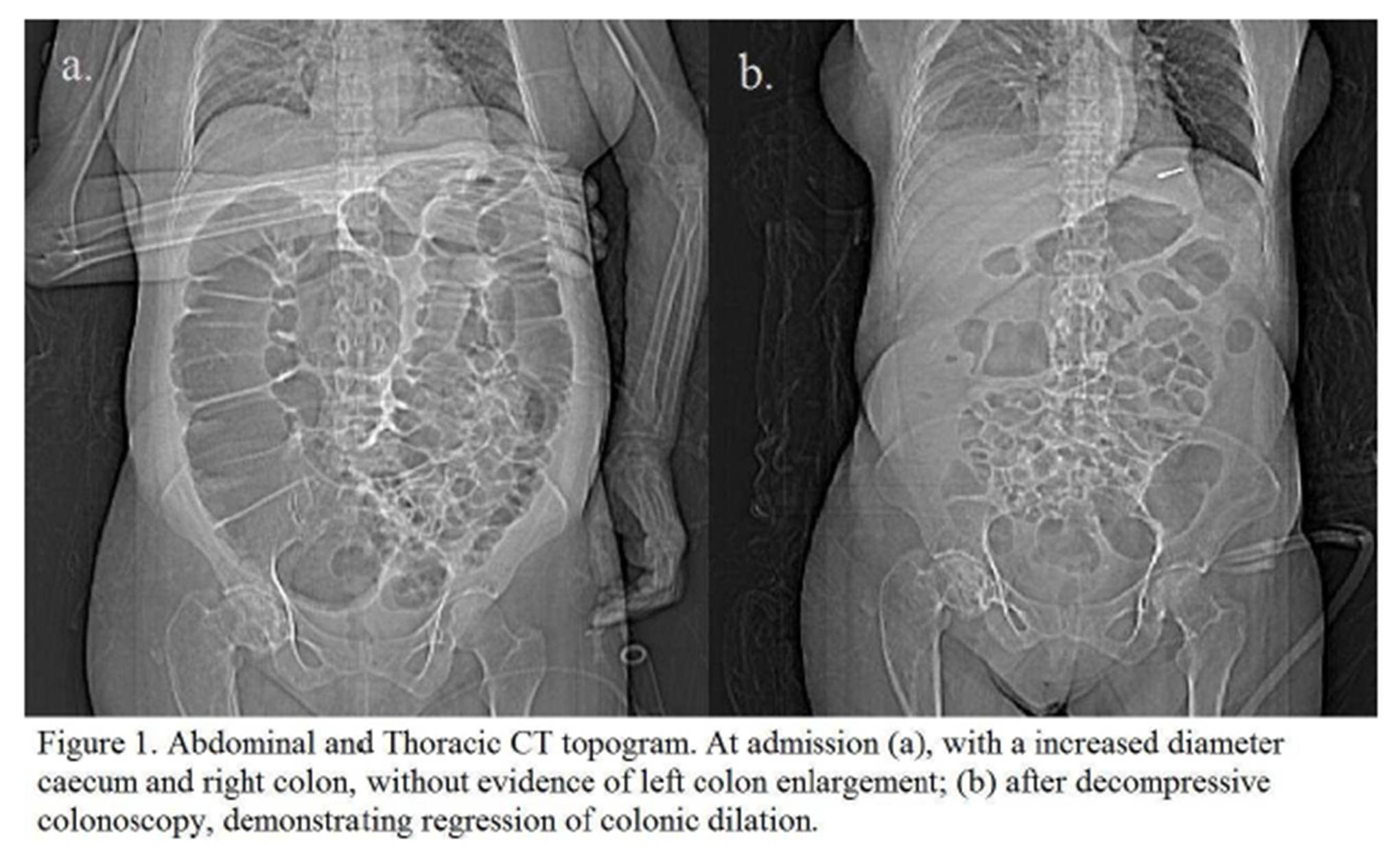 IBIMA Publishing The Giant Caecum with No Apparent Reason Ogilvie’s Syndrome