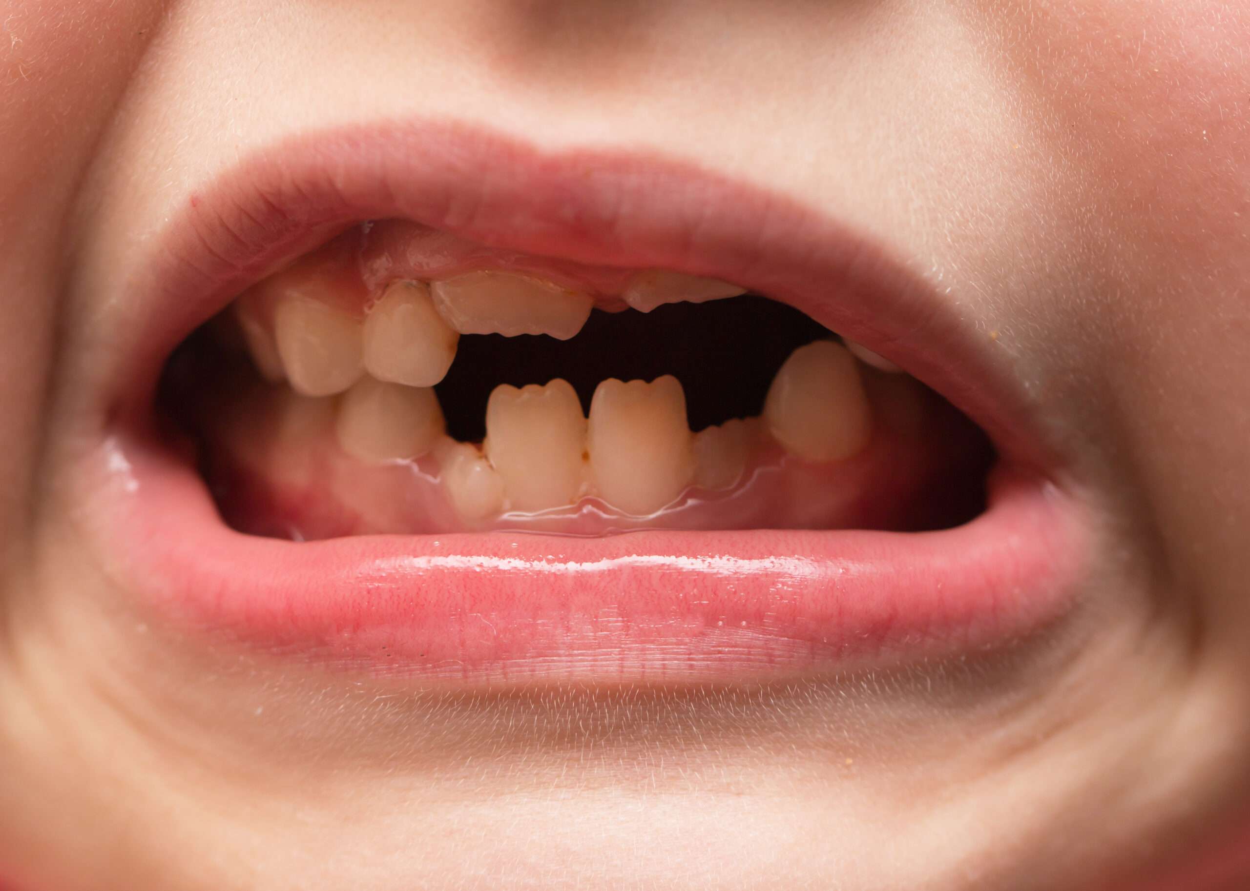 What are Teeth Made Out Of? Pediatric Dentistry of Central Florida