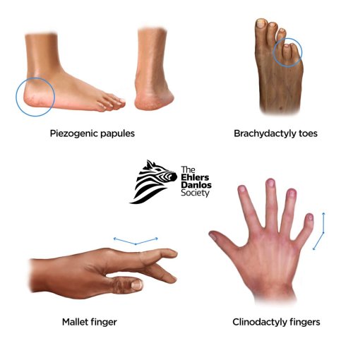 ClassicalLike EhlersDanlos Syndrome (clEDS) The Ehlers Danlos