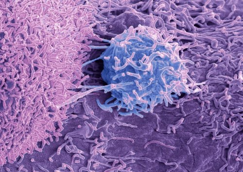 Advanced Prostate Cancer Treatment May Benefit from Autophagy Inhibitor