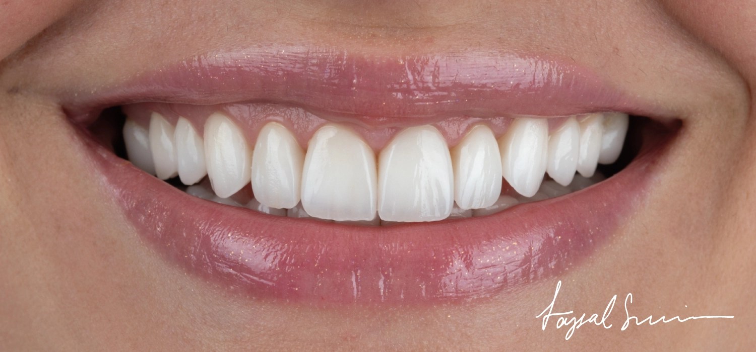 Affordable Dental Veneers in Abu Dhabi ICDE UAE